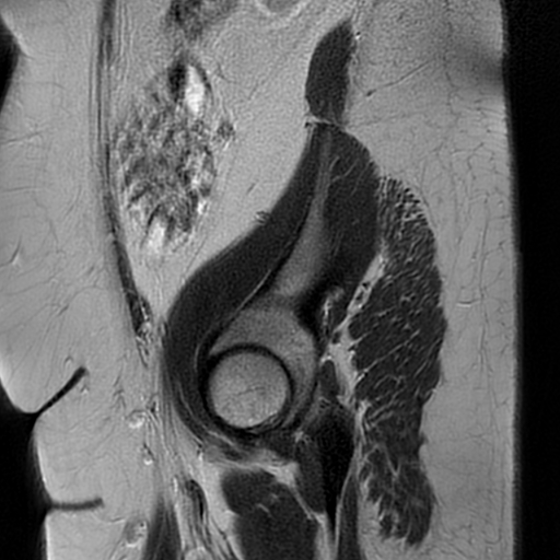 File:Adult granulosa cell tumor of the ovary (Radiopaedia 64991-73953 Sagittal T2 3).jpg