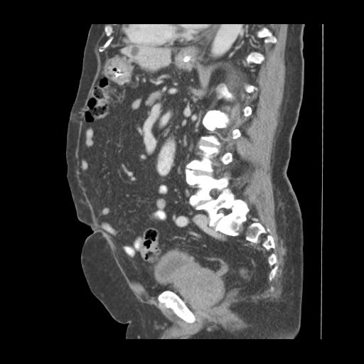 Adult ileal intussusception with secondary obstruction (Radiopaedia 30395-31051 Coronal C+ portal venous phase 62).jpg