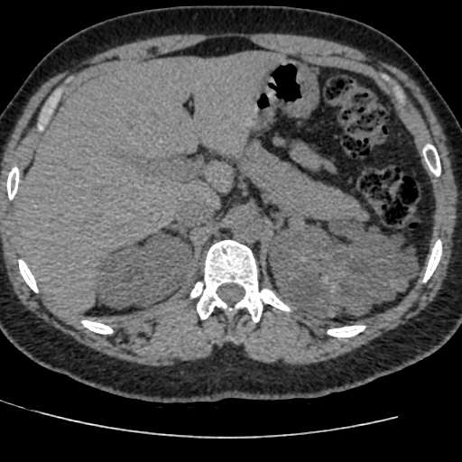 Adult polycystic kidney disease (Radiopaedia 59075-66368 Axial non-contrast 12).jpg