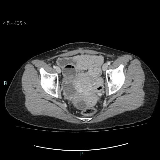 Adult transient intestinal intussusception (Radiopaedia 34853-36310 Axial C+ portal venous phase 105).jpg