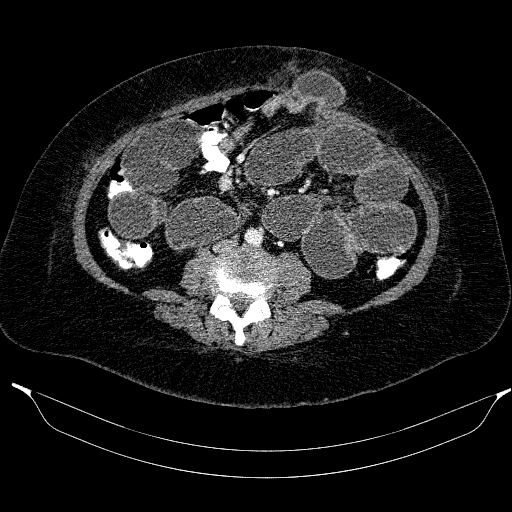 Afferent loop syndrome - secondary to incarcerated trocar site hernia (Radiopaedia 82959-97305 Axial C+ portal venous phase 138).jpg