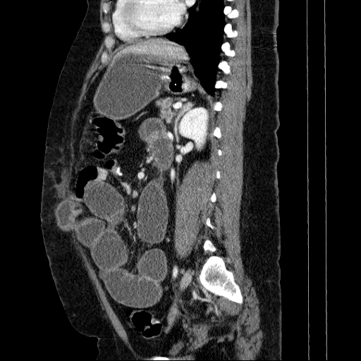 File:Afferent loop syndrome - secondary to incarcerated trocar site hernia (Radiopaedia 82959-97305 Sagittal C+ portal venous phase 61).jpg