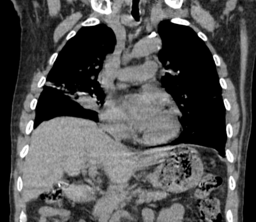 Airway foreign body in adult (Radiopaedia 85907-101779 Coronal liver window 114).jpg