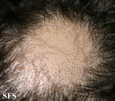 Alopecia Areata (Dermatology Atlas 13).jpg