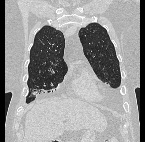 Alpha-1-antitrypsin deficiency (Radiopaedia 72058-82557 Coronal lung window 9).jpg