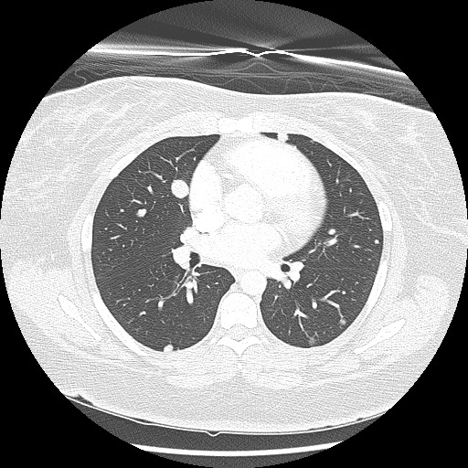 Alveolar soft part sarcoma - right leg (Radiopaedia 59432-67091 Axial lung window 56).jpg