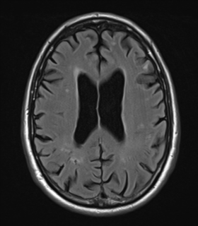File:Alzheimer's disease- with Gerstmann syndrome and dressing apraxia (Radiopaedia 54882-61150 Axial FLAIR 18).png