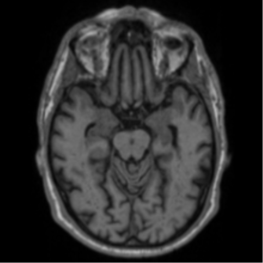Alzheimer's disease- with Gerstmann syndrome and dressing apraxia (Radiopaedia 54882-61150 Axial T1 28).png