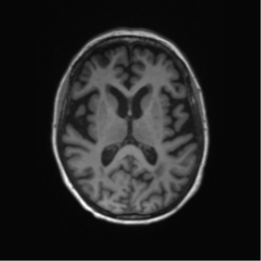 Alzheimer's disease (Radiopaedia 42658-45802 Axial T1 75).png