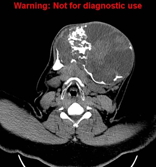File:Ameloblastoma (Radiopaedia 33126-34164 A 19).jpg