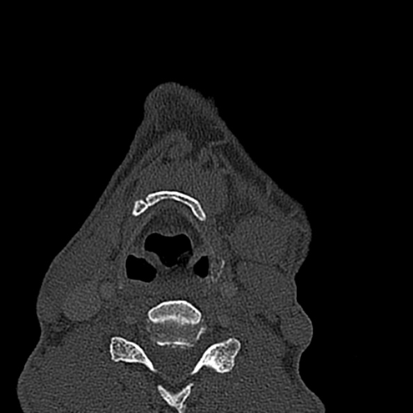 Ameloblastoma (Radiopaedia 51921-57766 Axial bone window 10).jpg