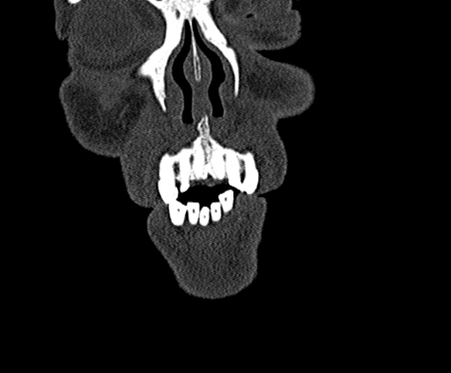 Ameloblastoma (Radiopaedia 51921-57766 Coronal bone window 15).jpg
