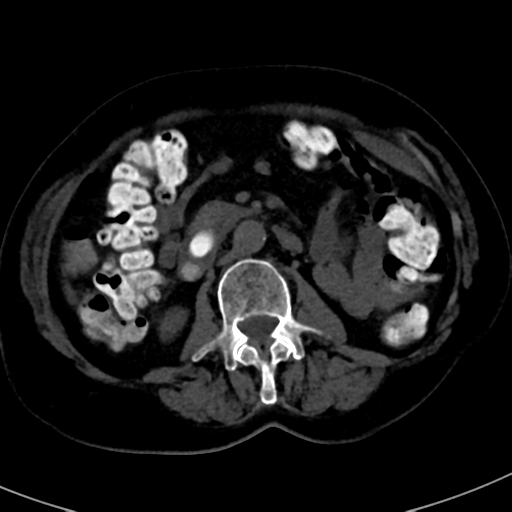 File:Ampullary adenocarcinoma (Radiopaedia 34013-35241 AXIAL THICK 47).png