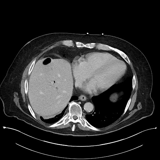 Ampullary adenocarcinoma (Radiopaedia 59373-66737 A 24).jpg