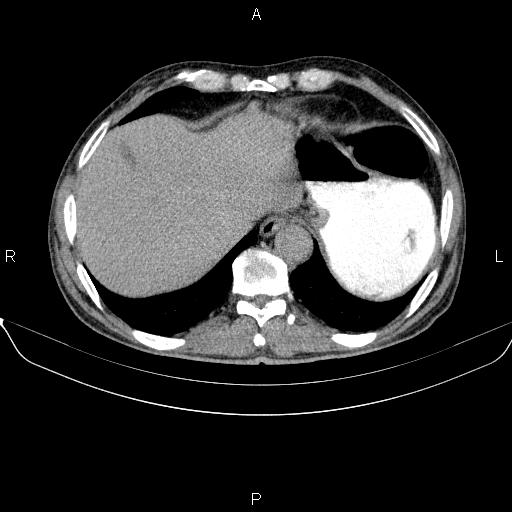 File:Ampullary adenocarcinoma (Radiopaedia 86093-102032 Axial C+ delayed 13).jpg