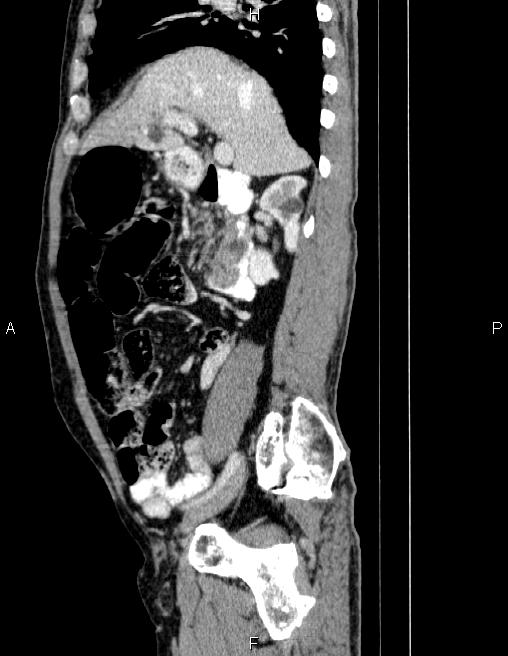 Ampullary adenocarcinoma (Radiopaedia 86093-102032 D 33).jpg