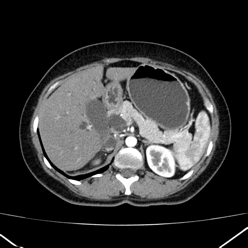 Ampullary tumor (Radiopaedia 22787-22816 B 28).jpg
