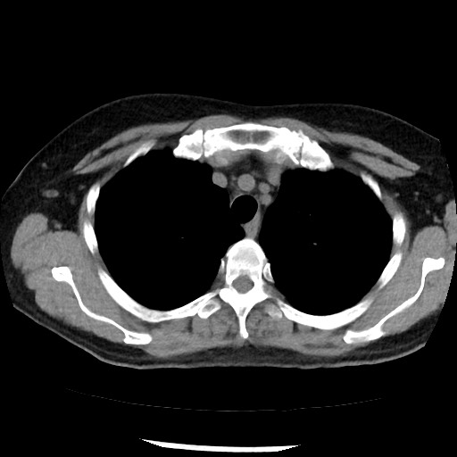 File:Amyloidosis - bronchial and diffuse nodular pulmonary involvement (Radiopaedia 60156-67744 Axial non-contrast 14).jpg