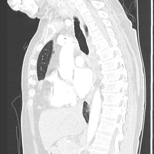 Amyloidosis - bronchial and diffuse nodular pulmonary involvement (Radiopaedia 60156-67745 Sagittal lung window 45).jpg