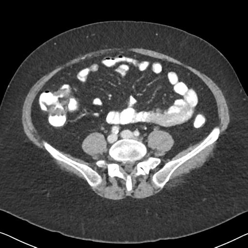 Anal adenocarcinoma - tumor regression grade 1 (Radiopaedia 31358-32103 Axial POST 47).jpg