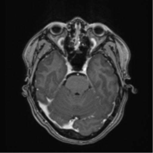 Anaplastic astroblastoma (Radiopaedia 55666-62194 Axial T1 C+ 24).png