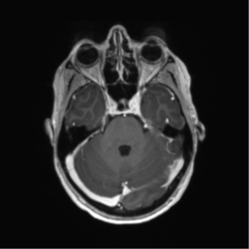 File:Anaplastic astrocytoma IDH mutant (Radiopaedia 50046-55341 Axial T1 C+ 16).png