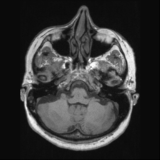 Anaplastic astrocytoma IDH wild-type (pseudoprogression) (Radiopaedia 42209-45276 Axial T1 39).png