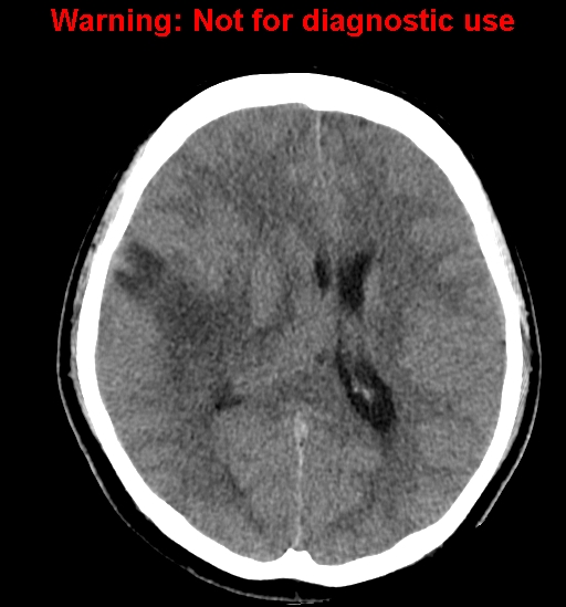 File:Anaplastic ganglioglioma (Radiopaedia 44921-48815 Axial non-contrast 16).jpg