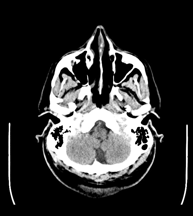 Anaplastic oligodendroglioma (Radiopaedia 79571-92753 Axial non-contrast 12).jpg