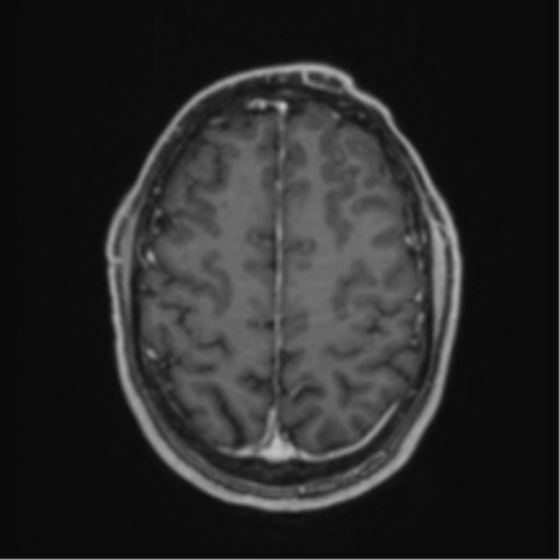 Anaplastic oligodendroglioma with skull fracture (Radiopaedia 74831-85845 Axial T1 C+ fat sat 51).png