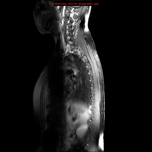 File:Aneurysmal bone cyst (Radiopaedia 9419-10103 Sagittal T1 fat sat 12).jpg