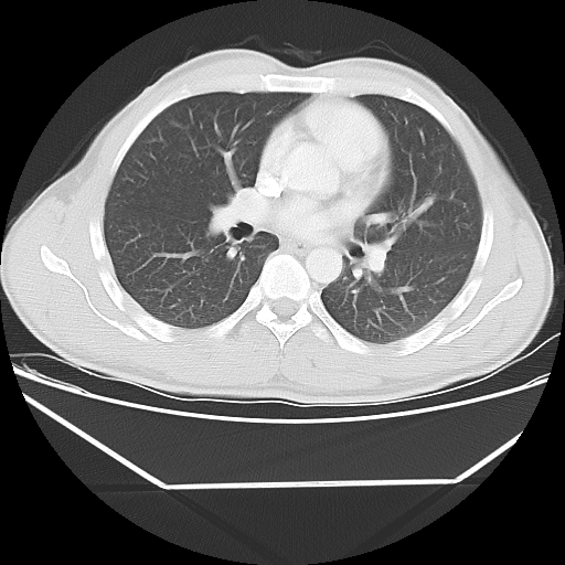 File:Aneurysmal bone cyst - rib (Radiopaedia 82167-96220 Axial lung window 35).jpg