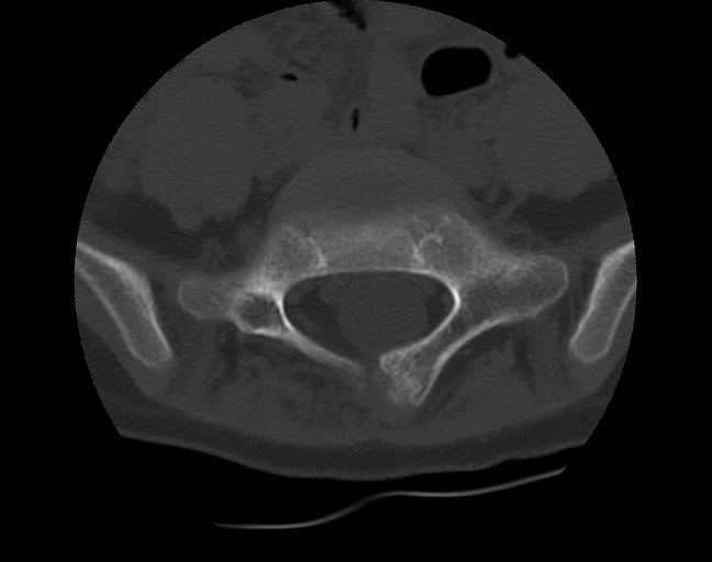 Aneurysmal bone cyst - sacrum (Radiopaedia 65190-74195 Axial bone window 15).jpg