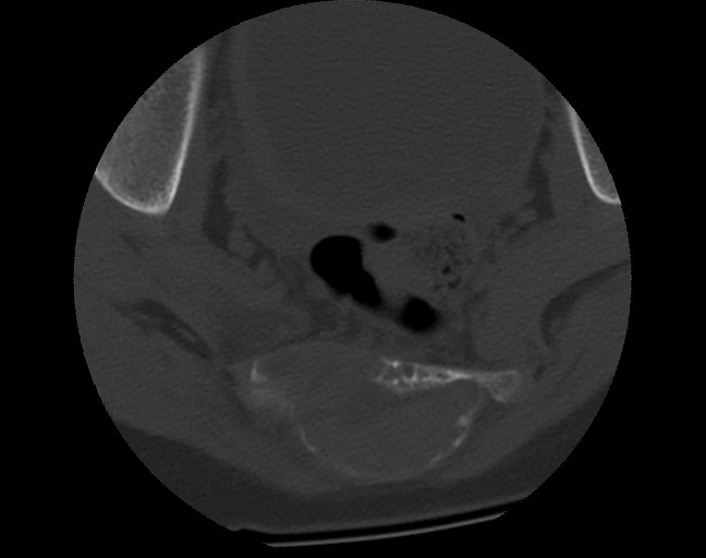 Aneurysmal bone cyst - sacrum (Radiopaedia 65190-74195 Axial bone window 36).jpg