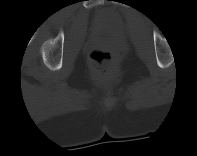 Aneurysmal bone cyst - sacrum (Radiopaedia 65190-74195 Axial bone window 51).jpg