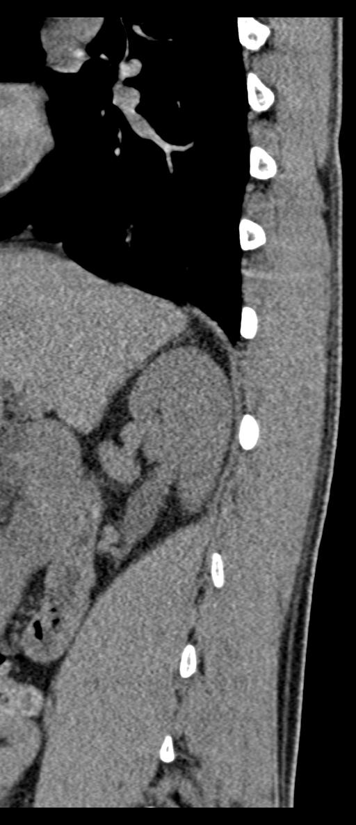 Aneurysmal bone cyst T11 (Radiopaedia 29294-29721 E 66).jpg