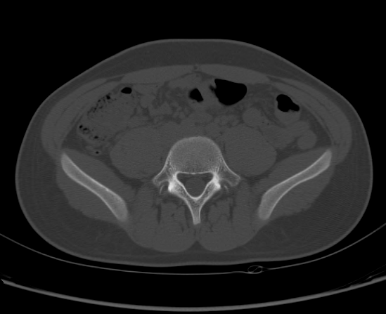 File:Aneurysmal bone cyst of ischium (Radiopaedia 25957-26094 Axial bone window 11).png