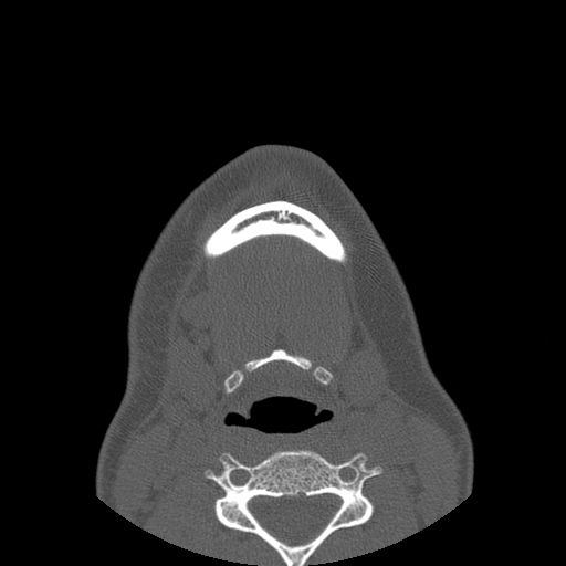 Aneurysmal bone cyst of the mandible (Radiopaedia 43280-46823 Axial bone window 10).jpg