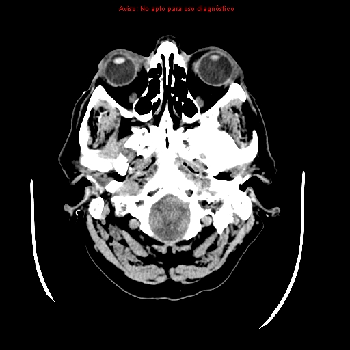 File:Aneurysmal subarachnoid hemorrhage (Radiopaedia 24740-24997 Axial non-contrast 4).jpg