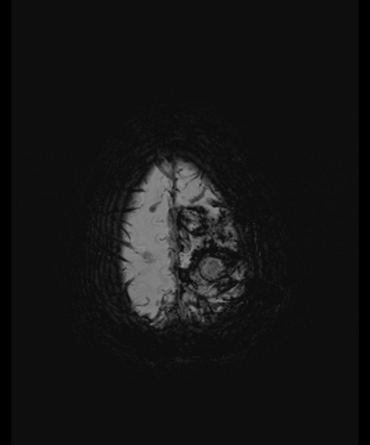 Angiomatous meningioma (Radiopaedia 79459-92579 E 58).jpg