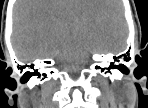 Angular dermoid cyst (Radiopaedia 88967-105790 Coronal non-contrast 77).jpg