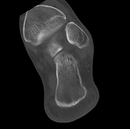 File:Anterior calcaneal process fracture (Radiopaedia 47384-51989 Coronal bone window 66).png