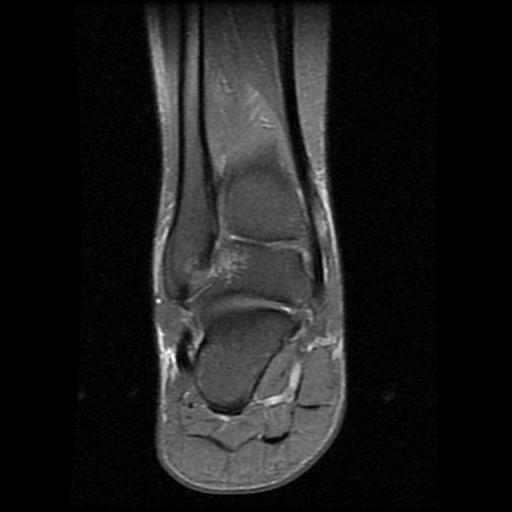 File:Anterior calcaneal process fracture (Radiopaedia 71377-81705 Coronal PD fat sat 10).jpg