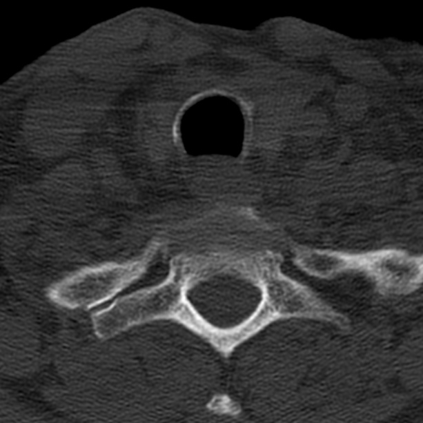 Anterior cervical postdiscectomy arthrodesis (Radiopaedia 32678-33646 Axial bone window 65).jpg