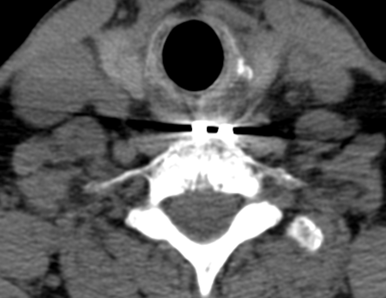 Anterior cervical postdiscectomy arthrodesis (Radiopaedia 32678-33646 Axial non-contrast 59).jpg