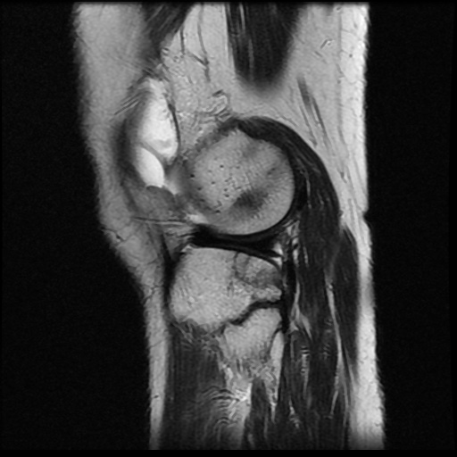 File:Anterior cruciate ligament avulsion fracture (Radiopaedia 58939-66193 Sagittal T2 5).jpg