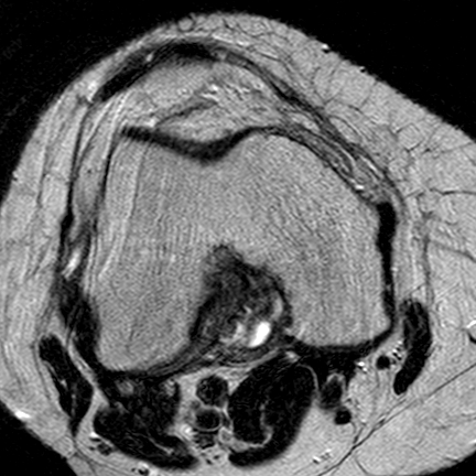 File:Anterior cruciate ligament mucoid degeneration (Radiopaedia 60853-68633 Axial T2 18).jpg