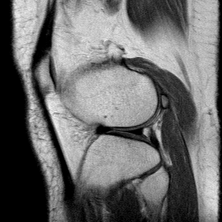 File:Anterior cruciate ligament mucoid degeneration (Radiopaedia 60853-68633 Sagittal PD 23).jpg