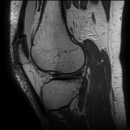 Anterior cruciate ligament rupture with Segond fracture (Radiopaedia 69043-78806 Sagittal PD 131).jpg