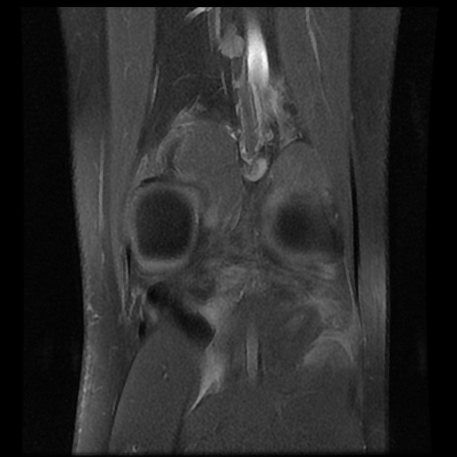 File:Anterior cruciate ligament tear (Radiopaedia 61500-69462 Coronal PD fat sat 17).jpg